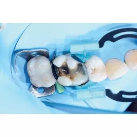 MyTines-zaciski do MyClip i MyRing Forte op. 6 par Polydentia